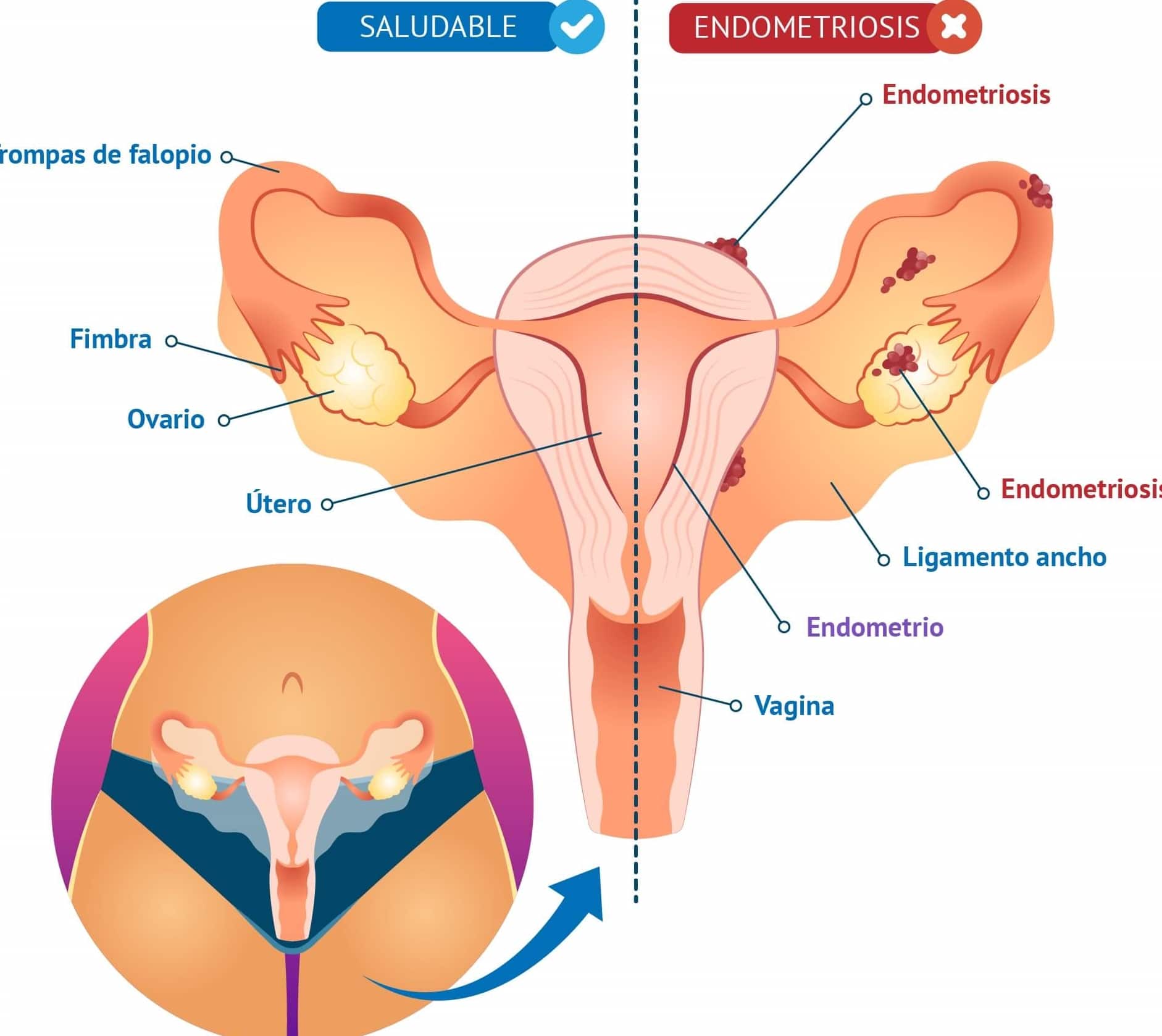 Día Mundial De La Endometriosis Anep 9440